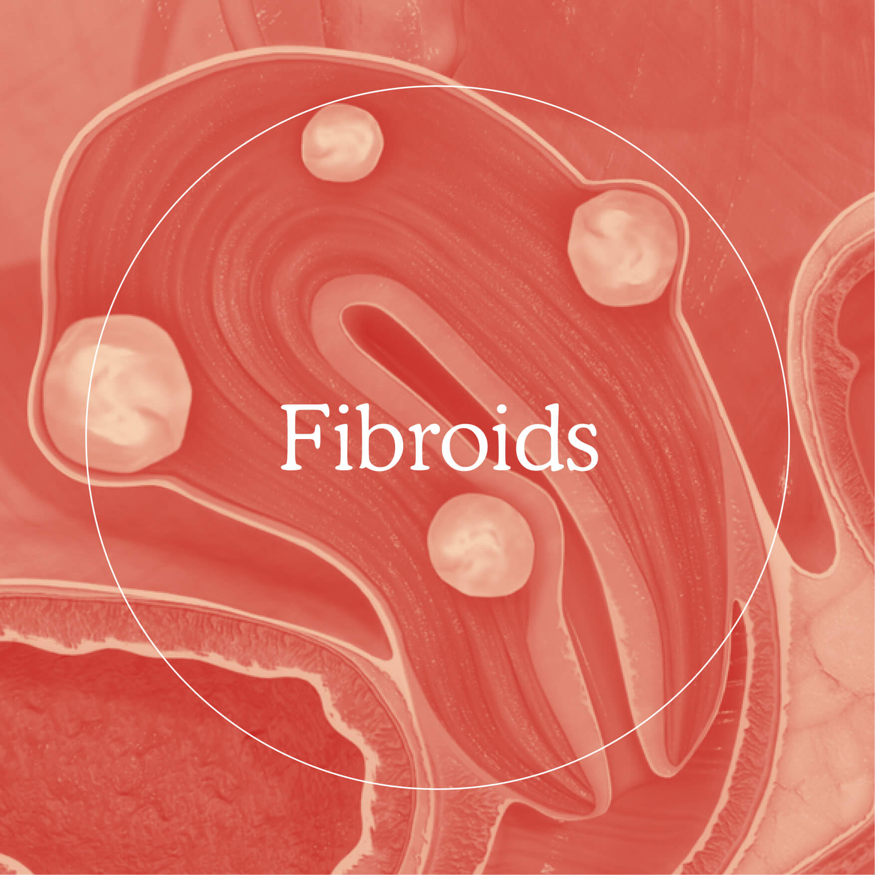 Could I have fibroids? – Myoovi